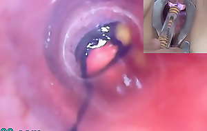 Mature Widely applicable Peehole Endoscope Camera in Bladder upon Balderdash